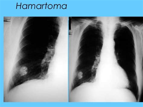 abnormal chest xray