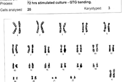 Is 46xx Karyotype Always A Female Bmj Case Reports