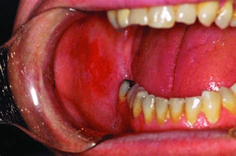 erythematous  atrophic variant  olp    buccal mucosa  scientific