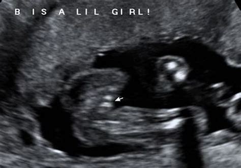 do you know how to tell it s a girl on an ultrasound