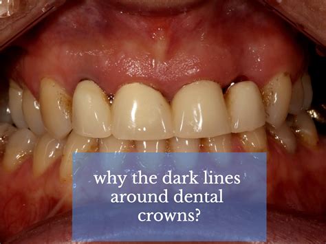 dental crowns  dark lines bic dental implants