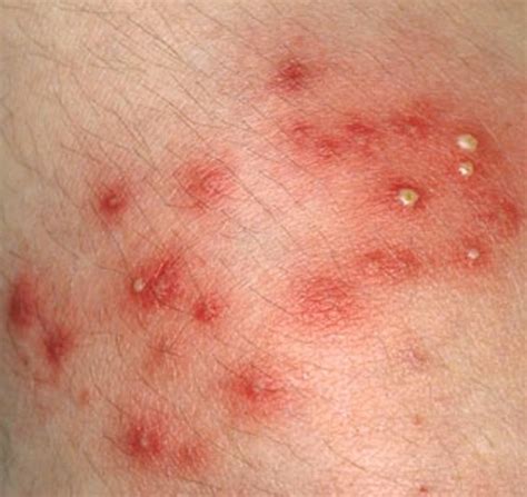 Staph Infection Causes Contagious Symptoms Treatment And Pictures
