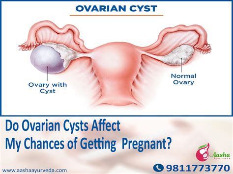 Ovarian Cysts 101 Causes Signs Treatment Myths – Artofit