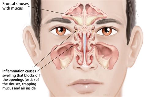 sinus infections otolaryngology specialists  north texas