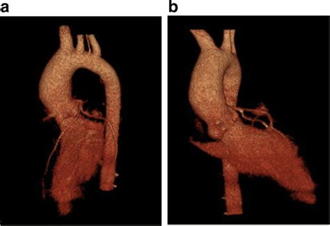 Congenital Aortic Stenosis Due To Unicuspid Unicommissural Aortic Valve
