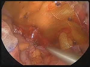 Laparoscopic Hernioplasty Using Omega 3 Coating Mesh