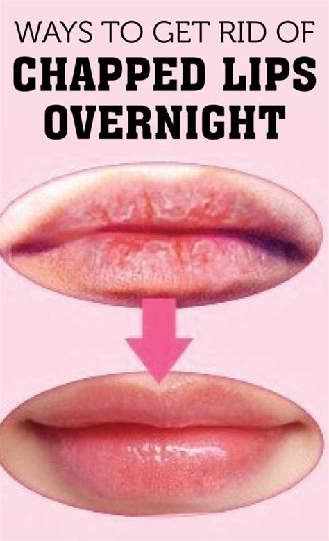 Ways To Get Rid Of Chapped Lips Overnight Chapped Lips Remedy Dry