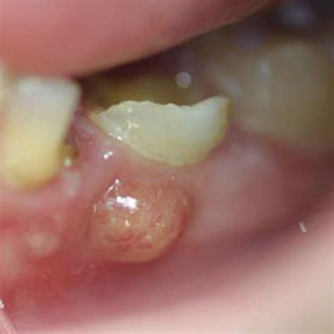 tooth abscess 5 stages symptoms pictures and treatment