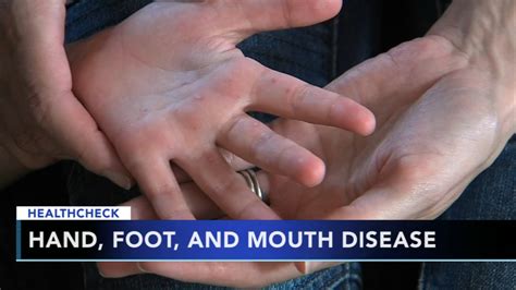 doctors seeing spike in hand foot and mouth disease abc7 san francisco