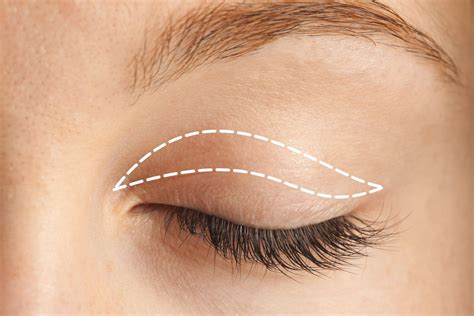 eyelid surgery  brow lift philadelphia pa blepharoplasty  forehead  removal