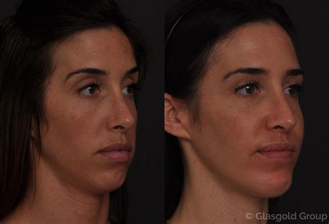 Facial Implants Princeton Nj Patient 30979