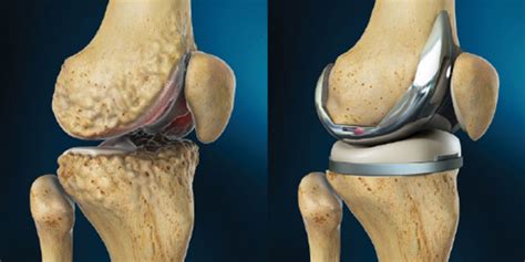 total knee replacement treatment in thane dr kuldeep gadkari