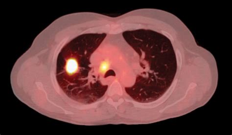 Multimodal Treatment Of Non Small Cell Lung Cancer The Lancet