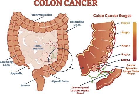 Do You Know That Colorectal Cancer Is The Third Most Common Cancer In