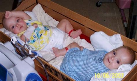 new life of conjoined twins 13 pics