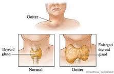 thyroid disease  goiter iexpress