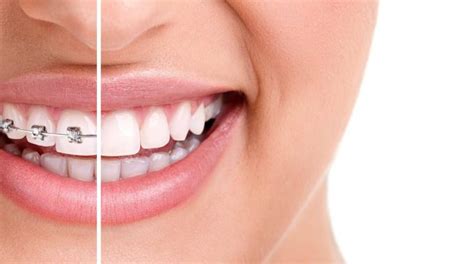 Top 5 Reasons To Get Invisalign Braces Braces And Smiles Invisalign