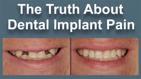 Real Facts About Affordable Dudley Dental Implants Fitness And Health