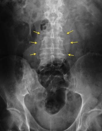 Atherosclerotic calcification of the abdominal aorta