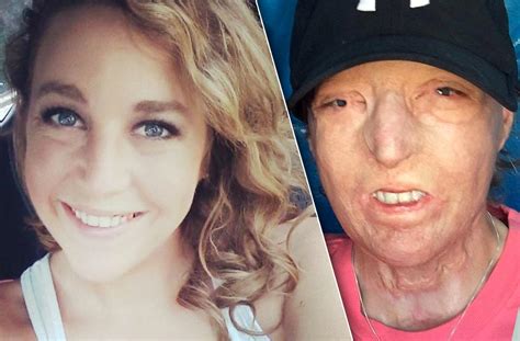 Burn Victim Courtney Waldons Mom Slams Monster Husband Who Left Her