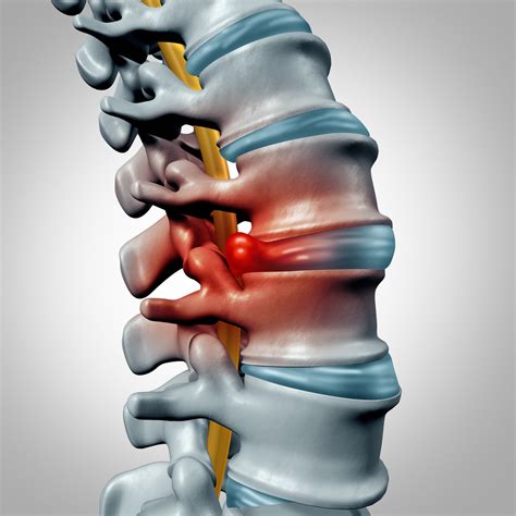 bulging disc disorder treatment nj north jersey spine group