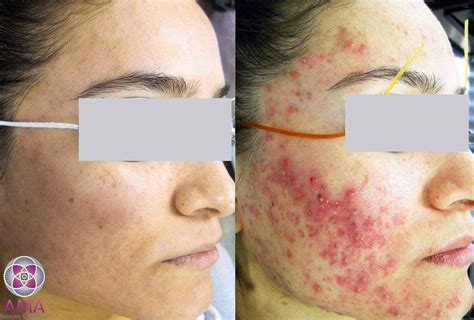 laser treatment  acne scars