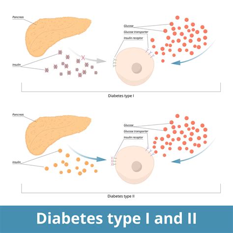 whats  difference  type   type  diabetes hubbard young