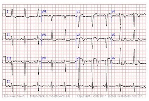 Are You Missing Subtle Mi Clues On Ecgs Test Your Skills