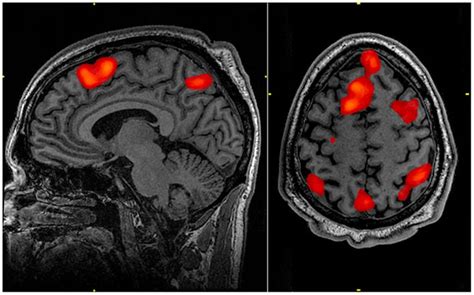 Mri Scan Detects Signs Of Schizophrenia Brain Imaging Test Predicts