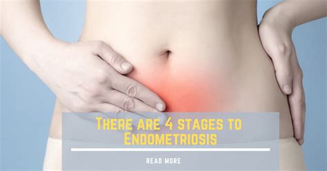 the four stages of endometriosis