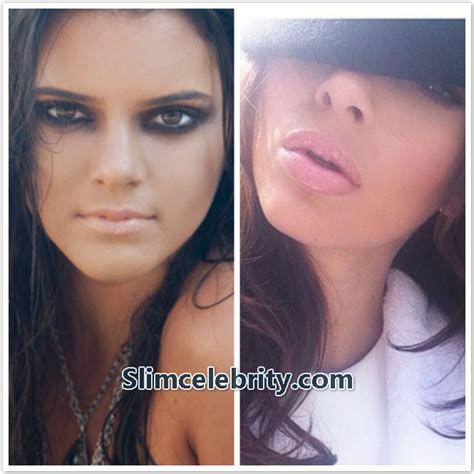 Kendall Jenner Plastic Surgery Before And After Photos
