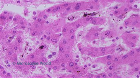 Microscope World Blog Cirrhosis Of The Liver