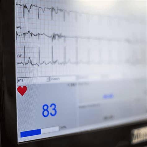 Heart Rate Variability How To Analyze Ecg Data