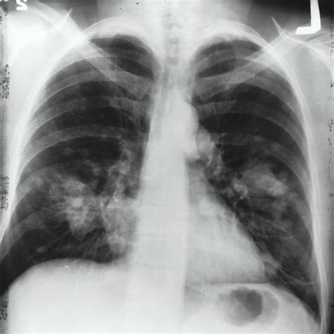 tuberculosis tb chest  ray  kaggle