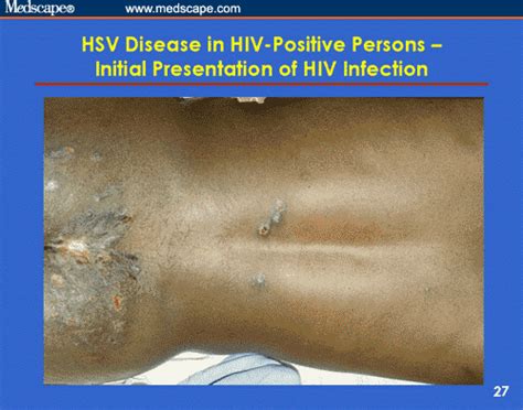 genital herpes in persons with or at risk for hiv infection prevention