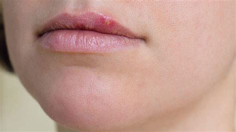 everything you think you know about herpes is wrong health