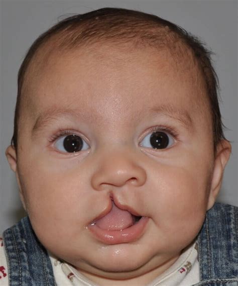 Cleft Lip And Palate Case 9
