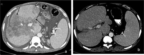Primary Hepatic Lymphoma A Axial Sections Of The Liver Showing