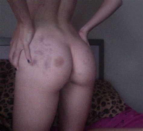 my bruised ass from being spanked and belted imgur
