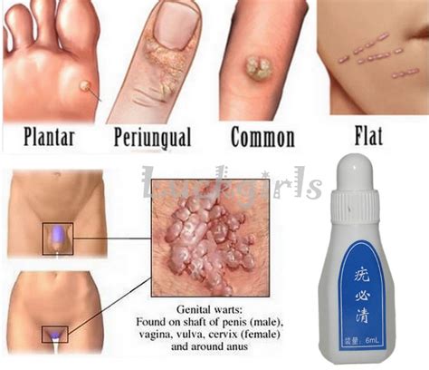Genital Wart Picures Genital Warts Symptoms Causes