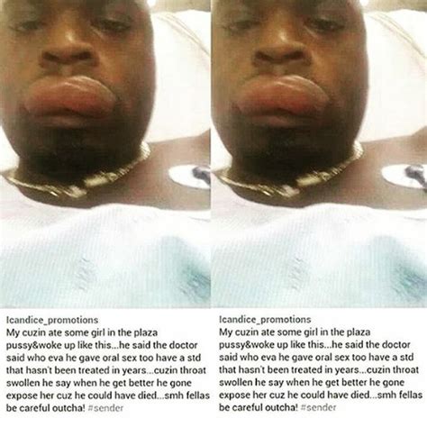 Man S Lips Swollen After Mouthaction With A Lady