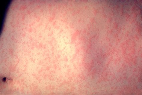 filemorbillivirus measles infectionjpg wikimedia commons