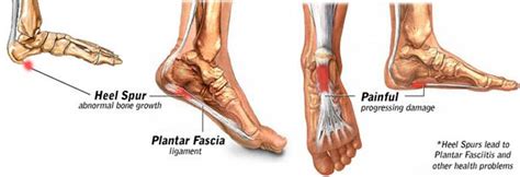 Heel Spur Symptoms And Treatments Heel That Pain