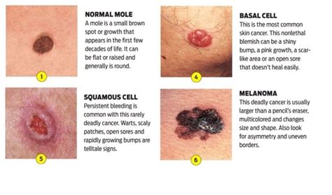 Symptoms Of Melanoma Skin Cancer Doctor Heck