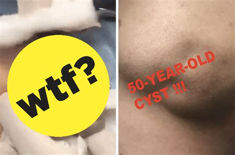 here s a video of a 50 year old cyst being popped and i m so sorry