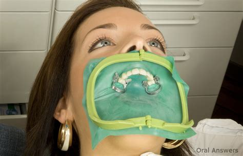 rubber dental dams      dentists   oral answers