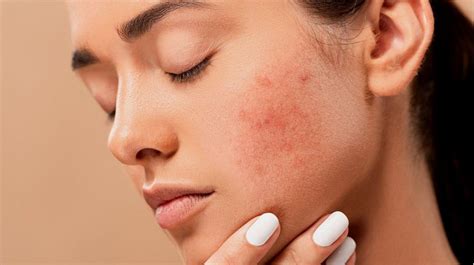 tips merawat kulit wajah kering elevatione luxury beauty skincare