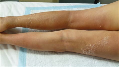 what s your diagnosis edematous erythema and subcutaneous plaques in lower extremities of
