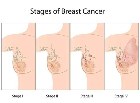 breast cancer typing and staging ⁄ cancer ~ healing with alternative methods