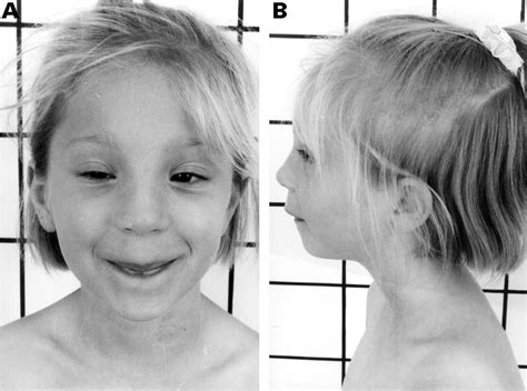 atypical clinical picture   nijmegen breakage syndrome   developmental